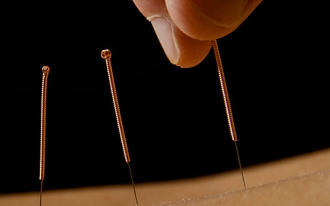 Acupuncture needles